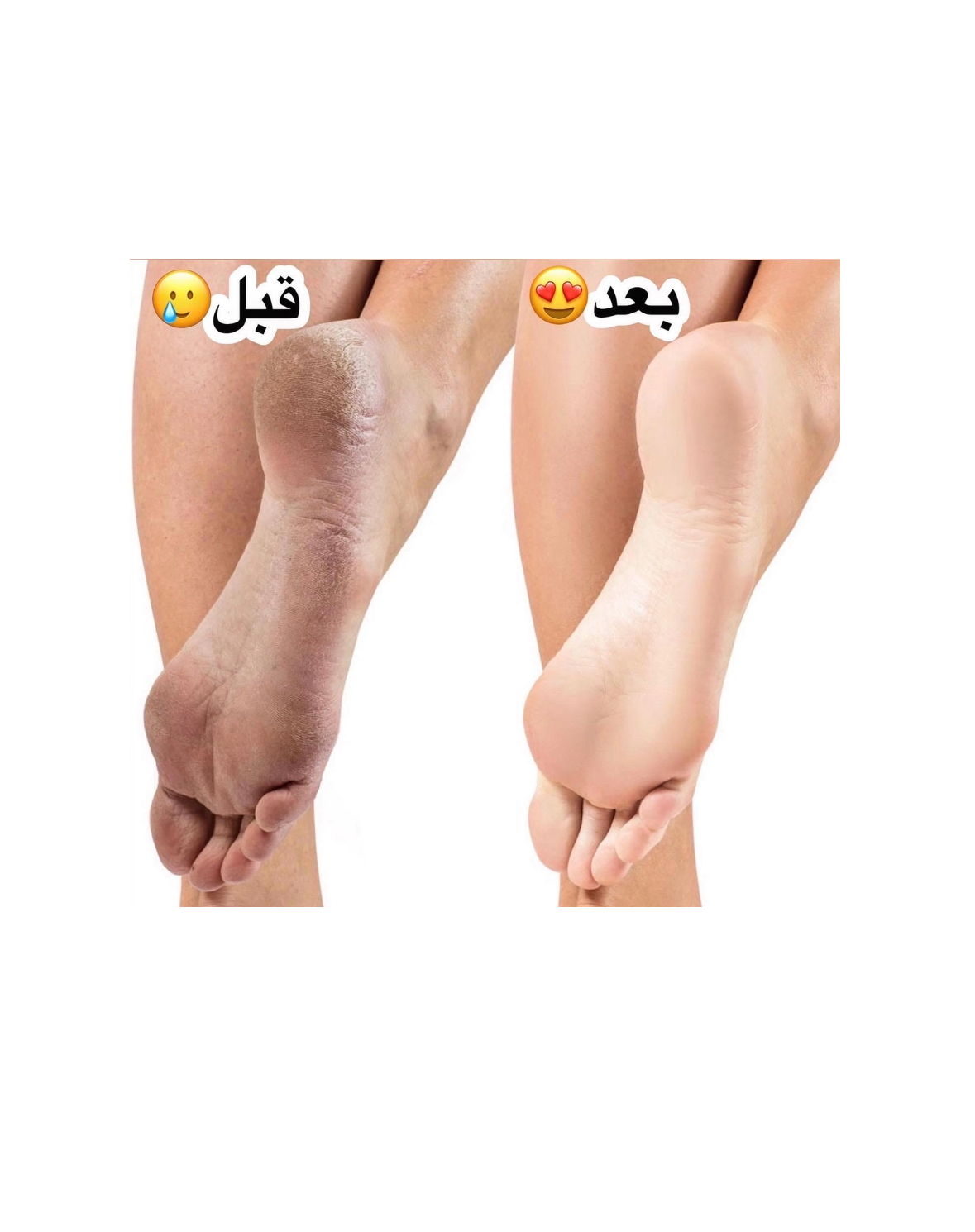 کرم ترک پا